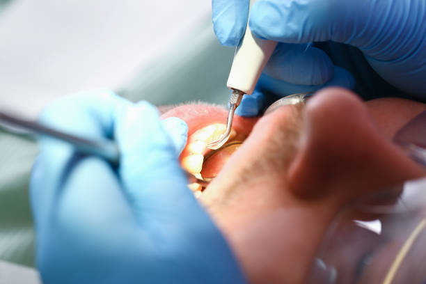 Best Chipped Tooth Repair Near Me  in Fairview, MT