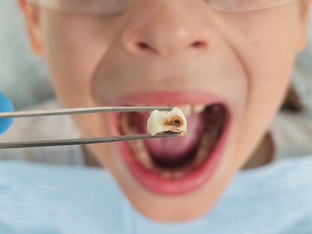 Best Emergency Tooth Extraction  in Fairview, MT